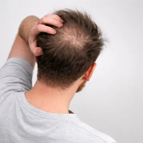 Calvície Progressiva