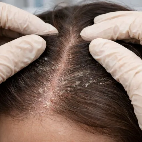 Caspa e Dermatites